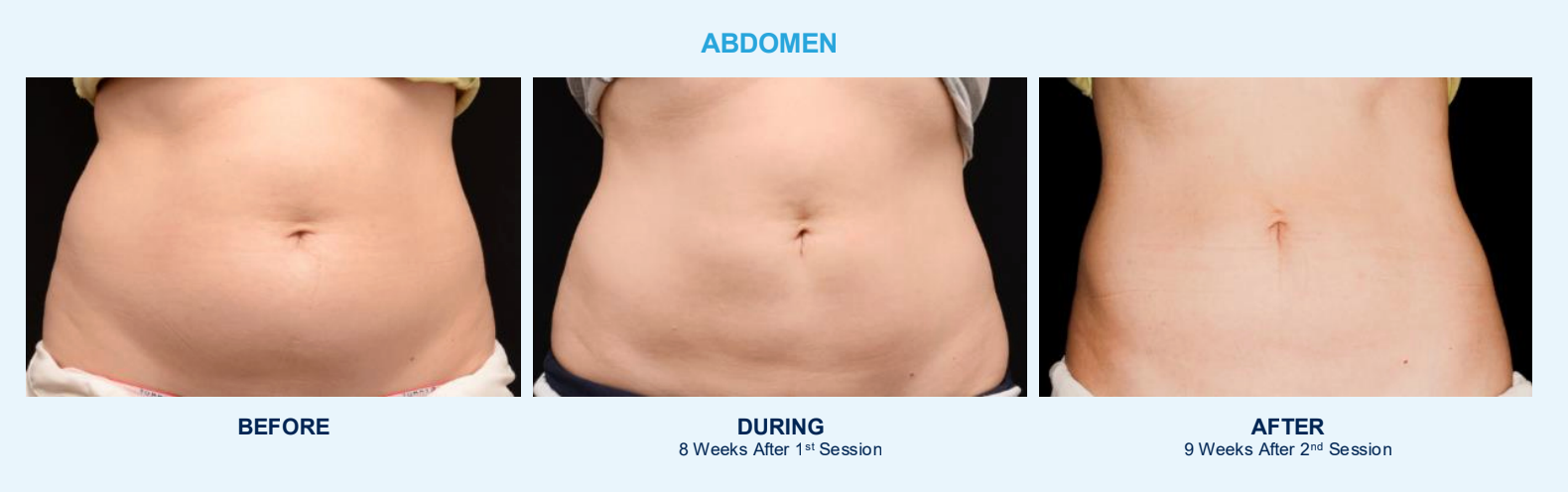 CoolSculpting Before & After - Abdomen