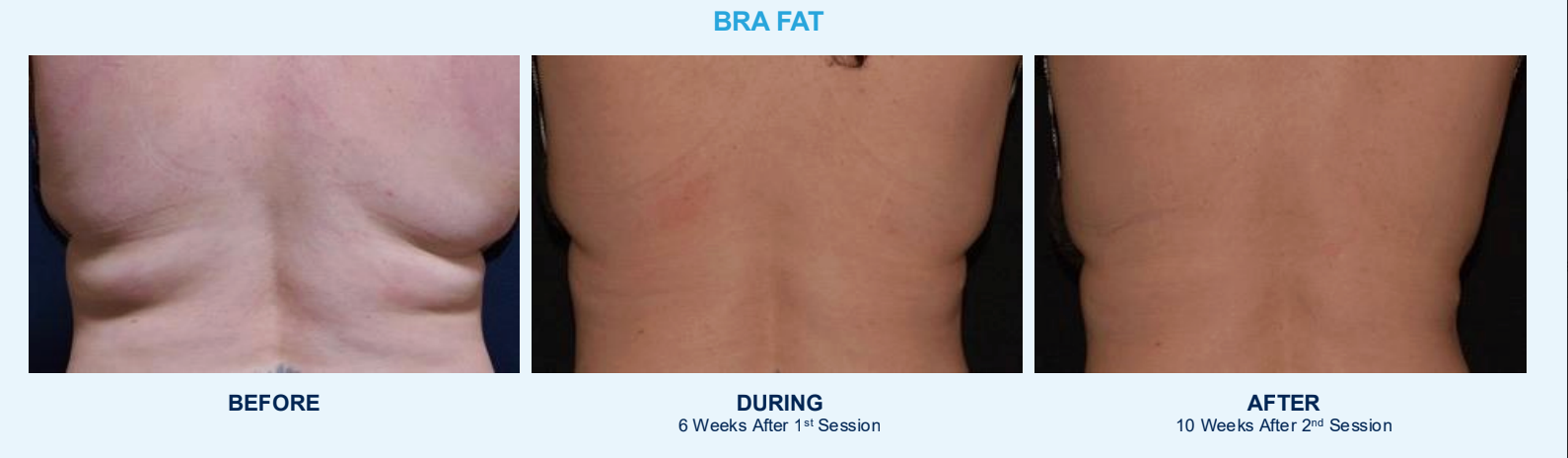 CoolSculpting Before & After